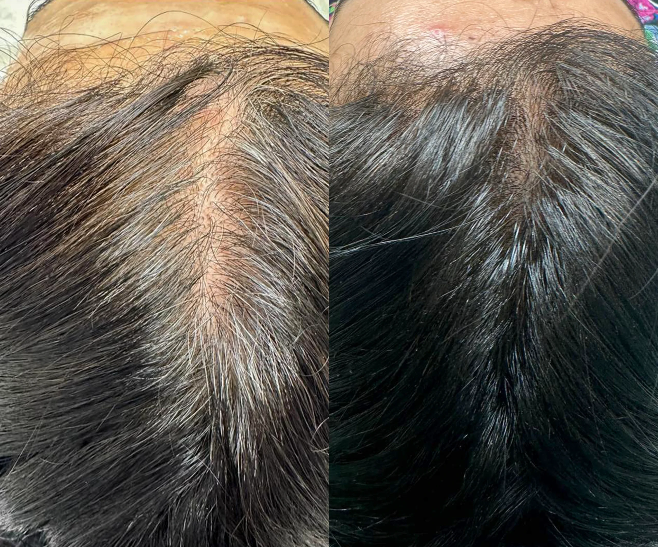 MCT Plasma & Stemcell Hair Before and after