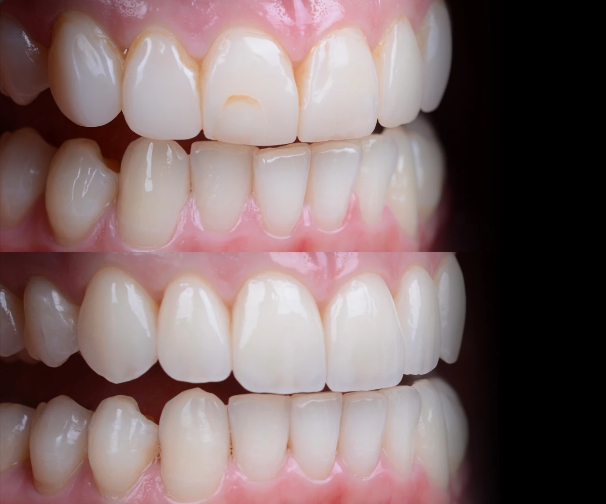 Invisalign then Veneers Before and after