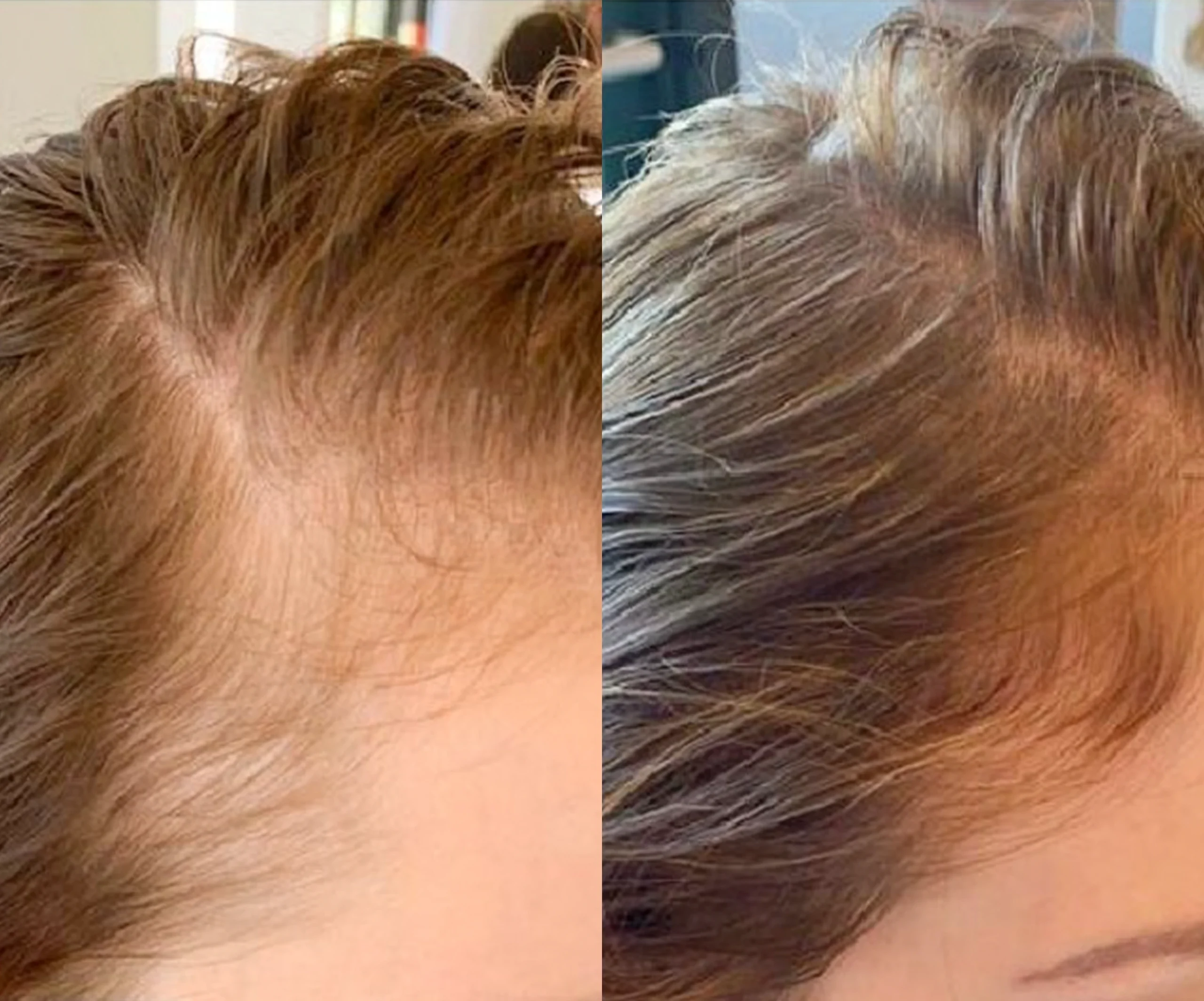 Jet Peel Hair Restoration Before and after