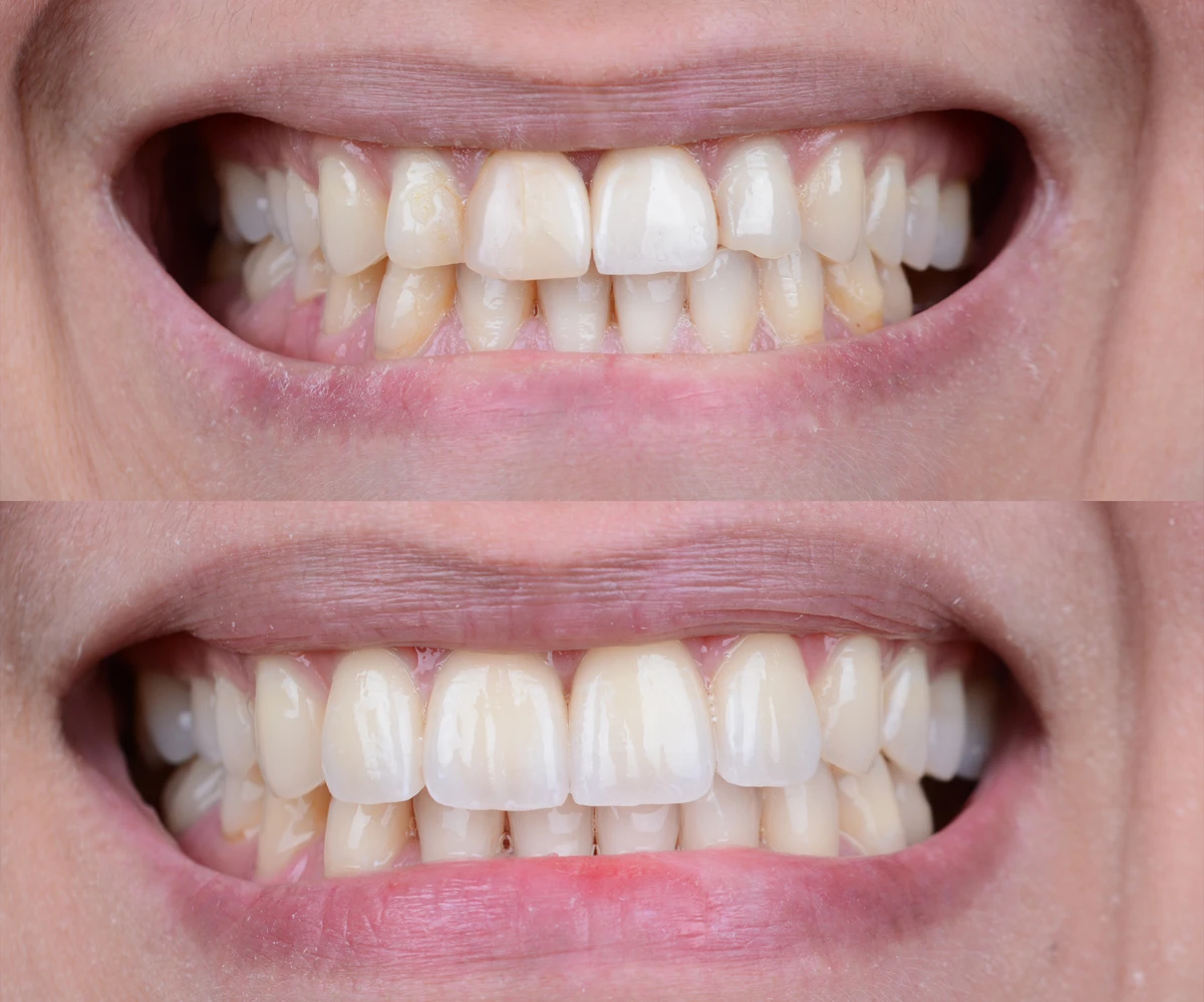 Refractory veneers 1 image Before and after