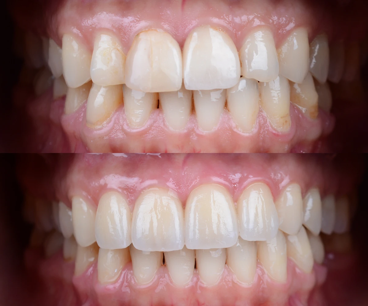Refractory veneers 2 image Before and after