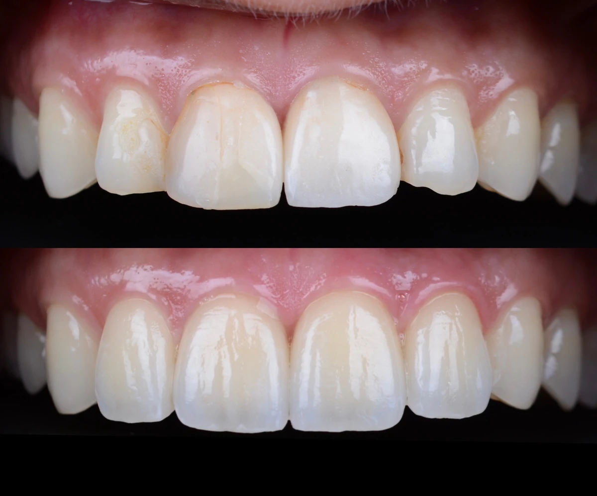 Refractory veneers 3 image Before and after