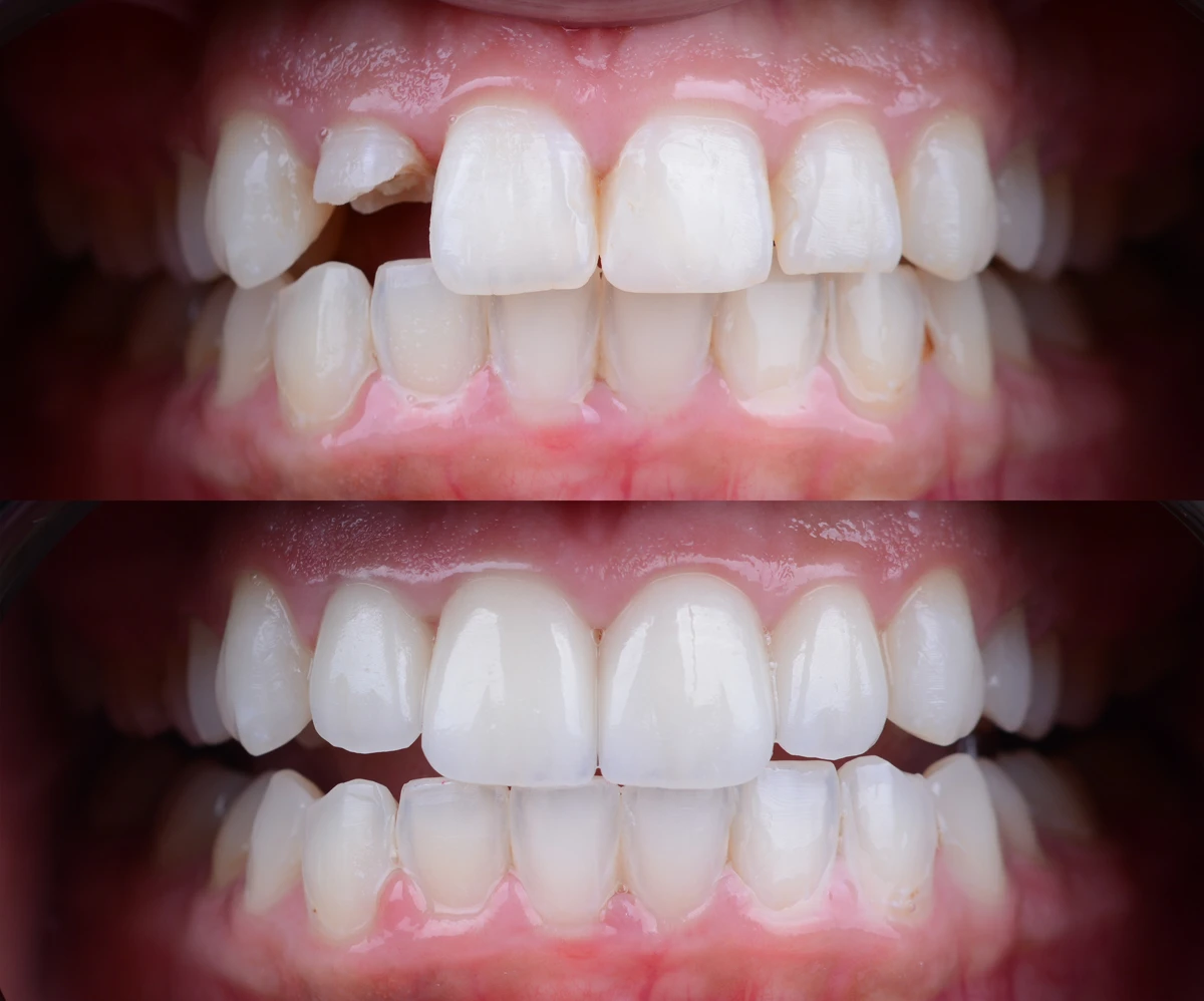 Refractory veneers 4 Before and after
