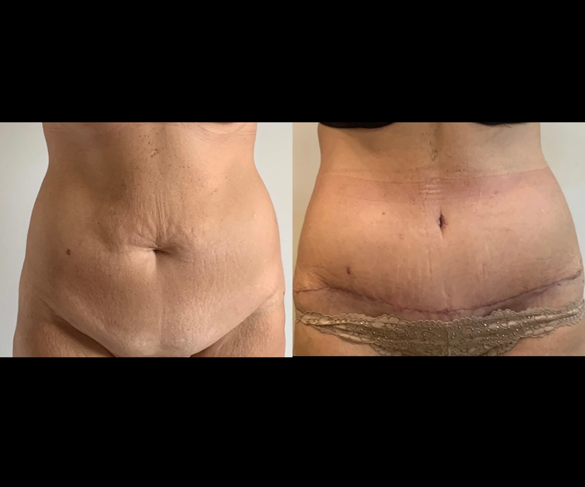 Tummy Tuck before and after