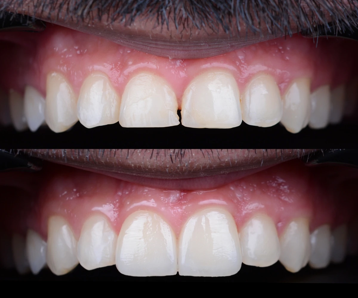 Refractory veneers Before and after