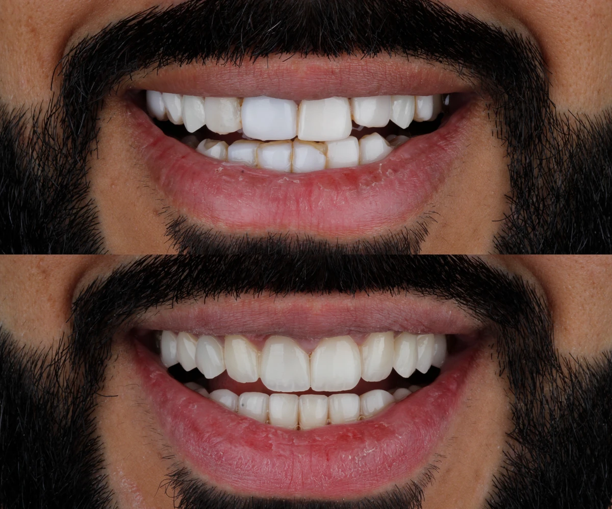 Veneers 1 Before and after