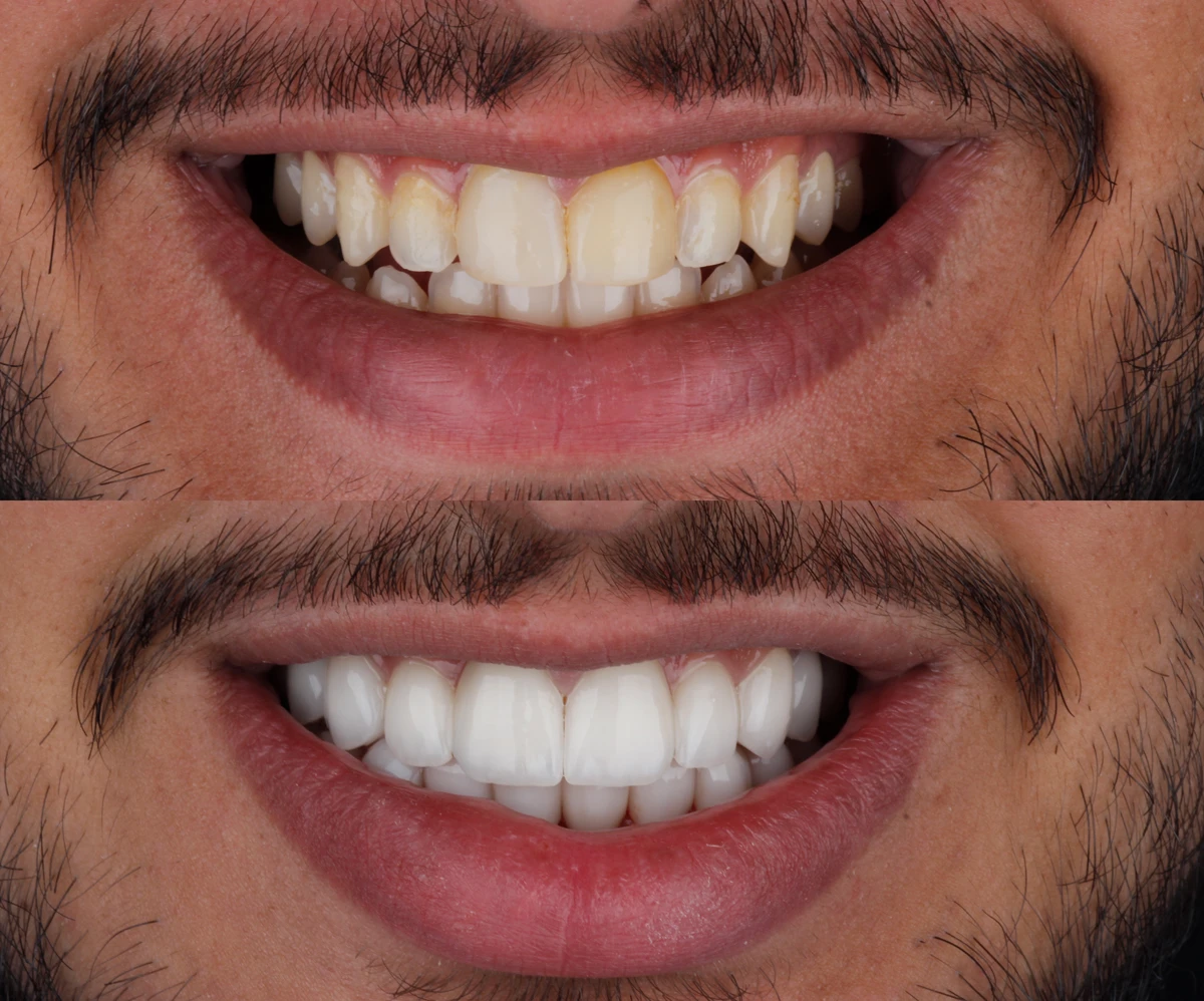 Veneers 2 Before and after