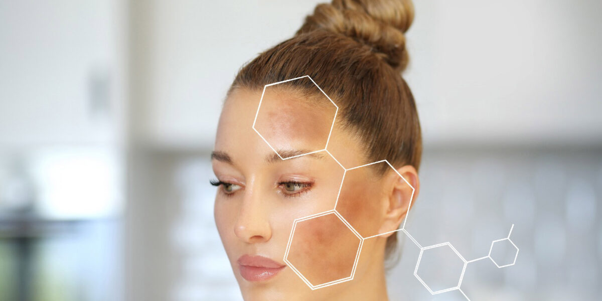 Pigmentation Treatment Dubai