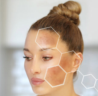 Pigmentation Treatment Dubai