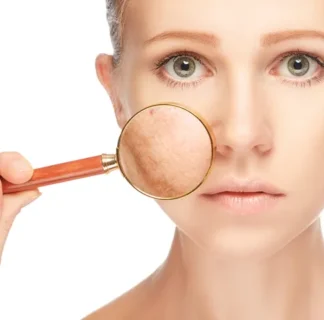 Pigmentation Treatment