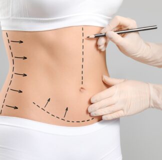 Tummy Tuck in Dubai